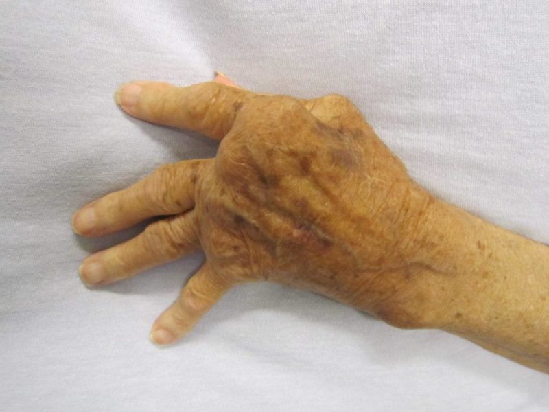 A hand severely affected by rheumatoid arthritis. Photo by <a href="https://commons.wikimedia.org/wiki/File:Rheumatoid_Arthritis.JPG" rel="noopener" target="_blank">James Heilman, MD <a href="https://creativecommons.org/licenses/by-sa/3.0/deed.en" rel="noopener" target="_blank">(license)</a>